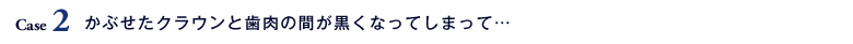 Case2 かぶせたクラウンと歯肉の間が黒くなってしまって…